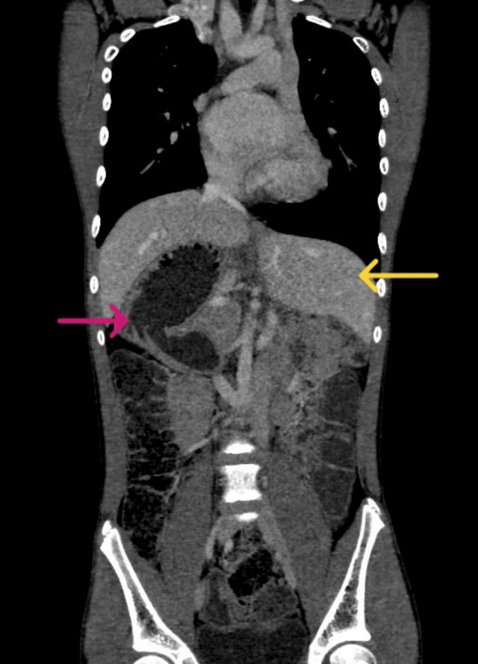 Computed-tomography-of-the-abdomen-(coronal-view)-showing-situs-inversus-with-liver-in-the-left-hypochondrium-(yellow-arrow)-and-right-sided-stomach-(pink-arrow).