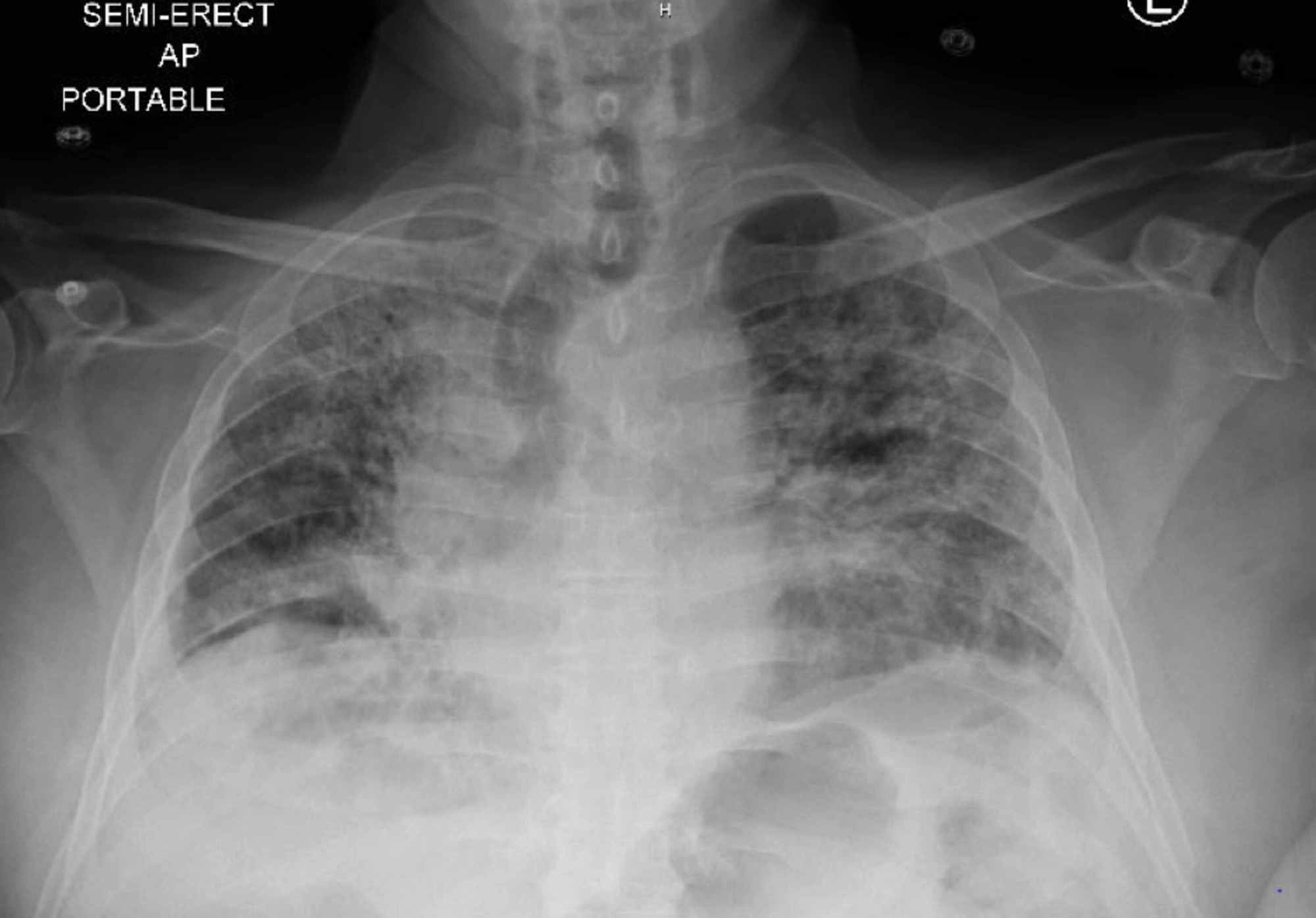 Infiltrates On Chest X Ray