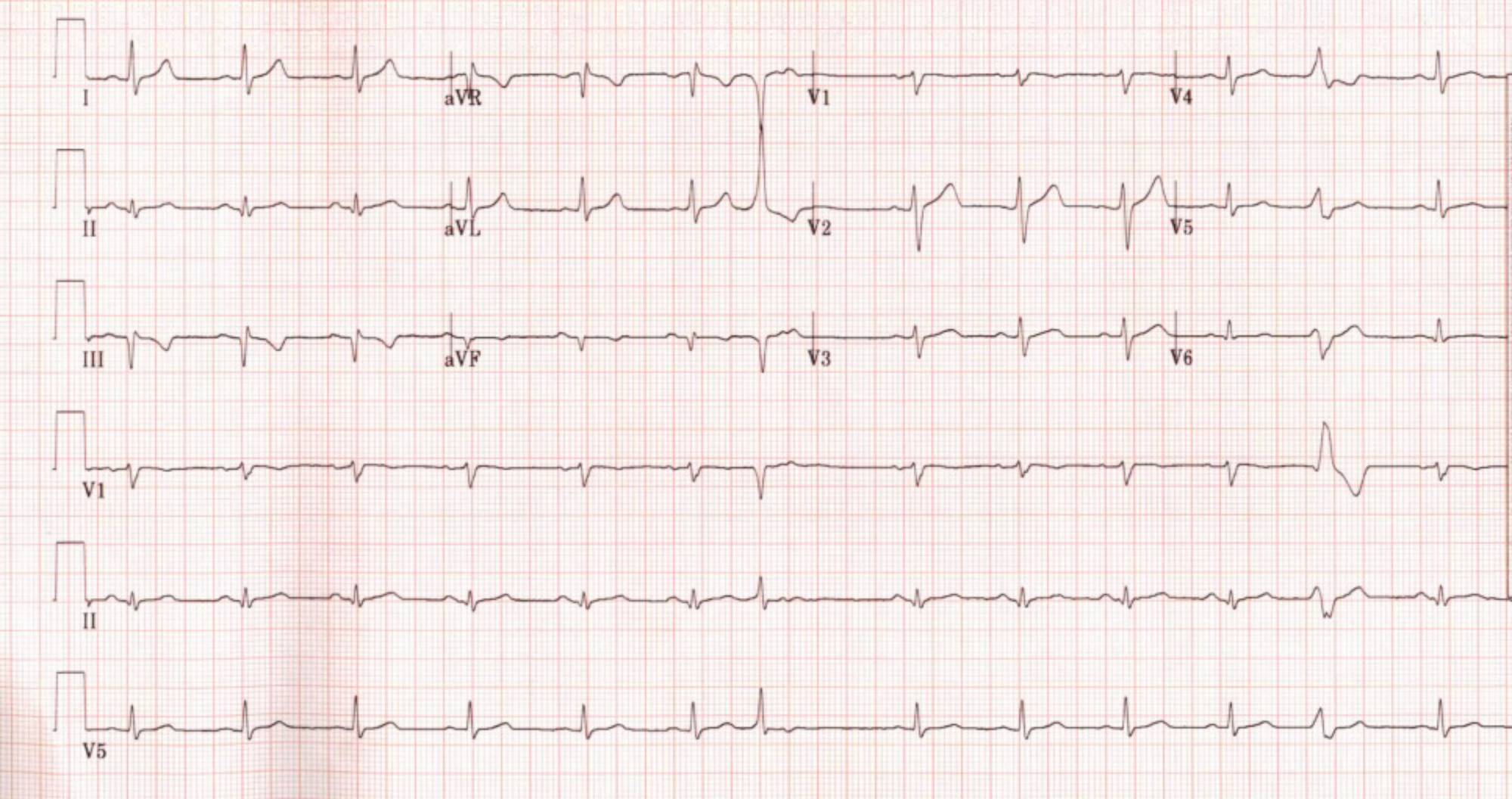 cureus-uncommon-anatomic-predisposition-to-myocardial-infarction-a