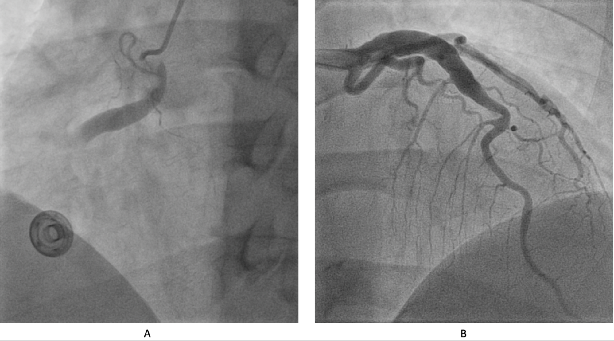 Cureus | Uncommon Anatomic Predisposition to Myocardial Infarction: A Case of Coronary Artery ...