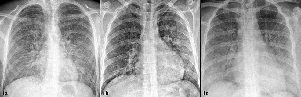 a-c:-Initial-chest-X-ray-at-presentation.-From-left-to-right:-Patient-1,-Patient-2,-Patient-3.-1a-“Extensive-bilateral-ground-glass-and-interstitial-lung-opacities.”-1b-“Extensive-bilateral-patchy-opacities,-greater-in-the-left-lung.”--1c-“Diffuse,-bilateral,-ground-glass-lung-opacities-with-hazy-appearance,-vascular-congestion.”