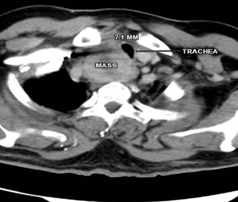 Transverse-section-of-PET-CT-at-C7-D1-level.