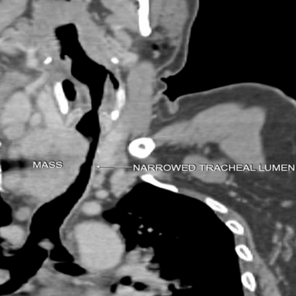 Sagittal-section-of-PET-CT-showing-narrowed-tracheal-lumen-at-C7-D1-vertebral-level.
