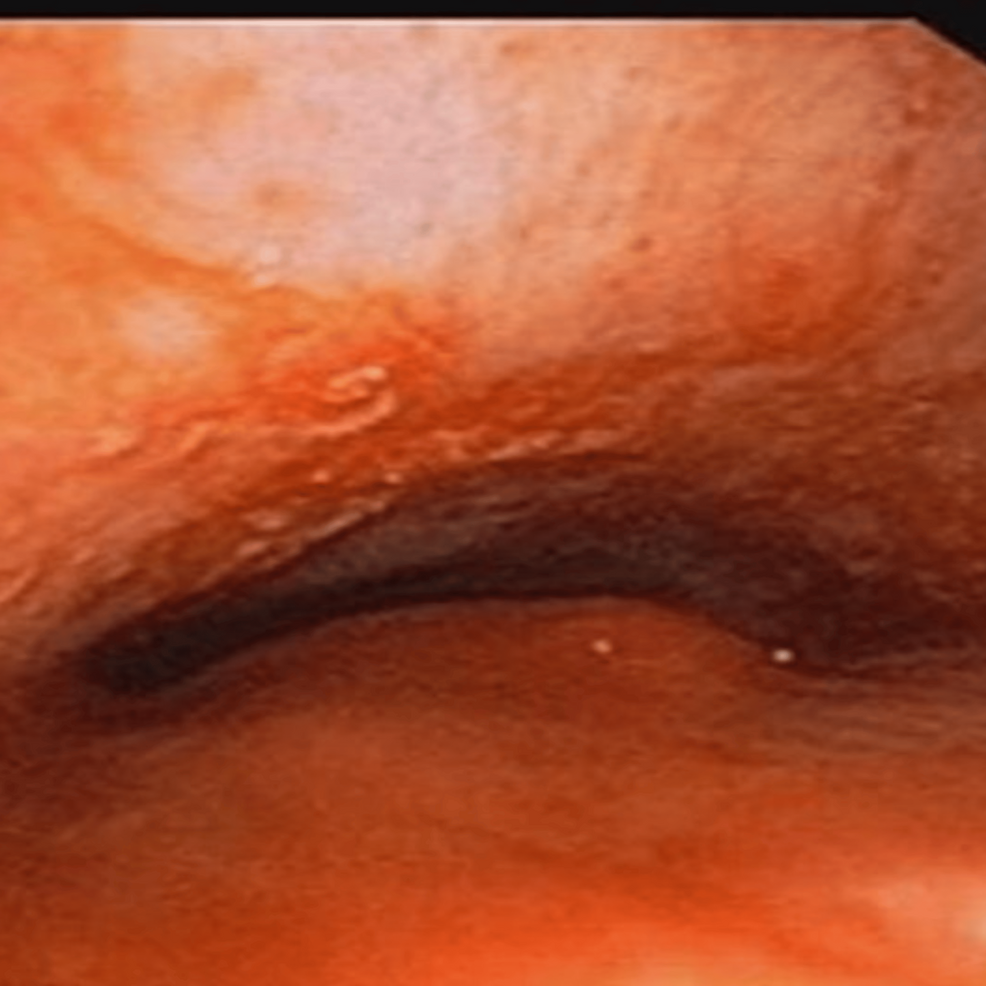 Flexible-video-bronchoscopy-showing-tracheal-lumen-narrowing-with-nodular-infiltration.