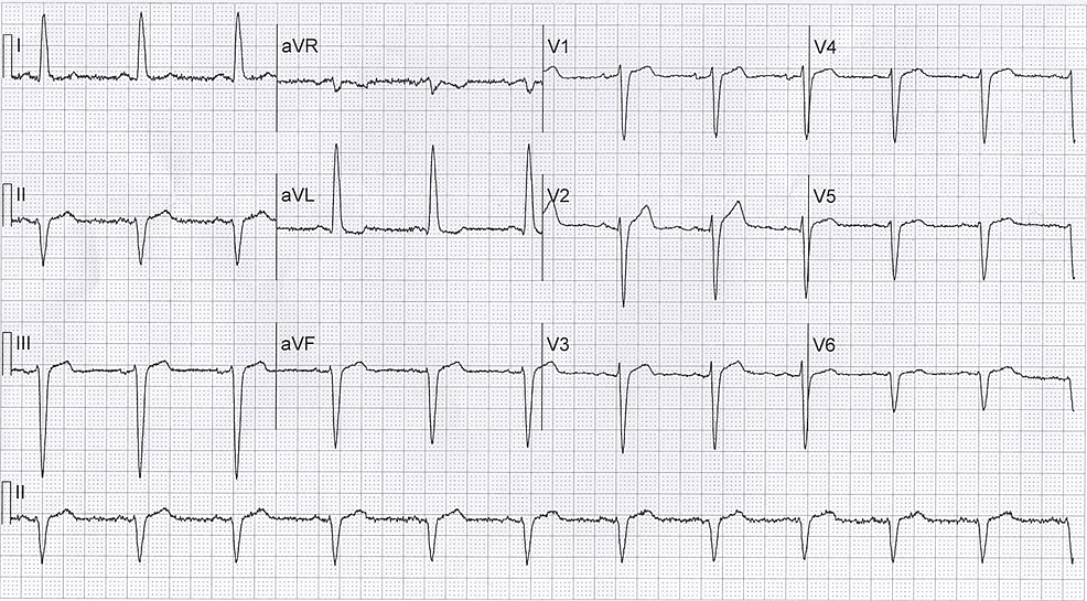 Cureus | Transient Giant R Wave as a Marker for Ischemia in Unstable Angina