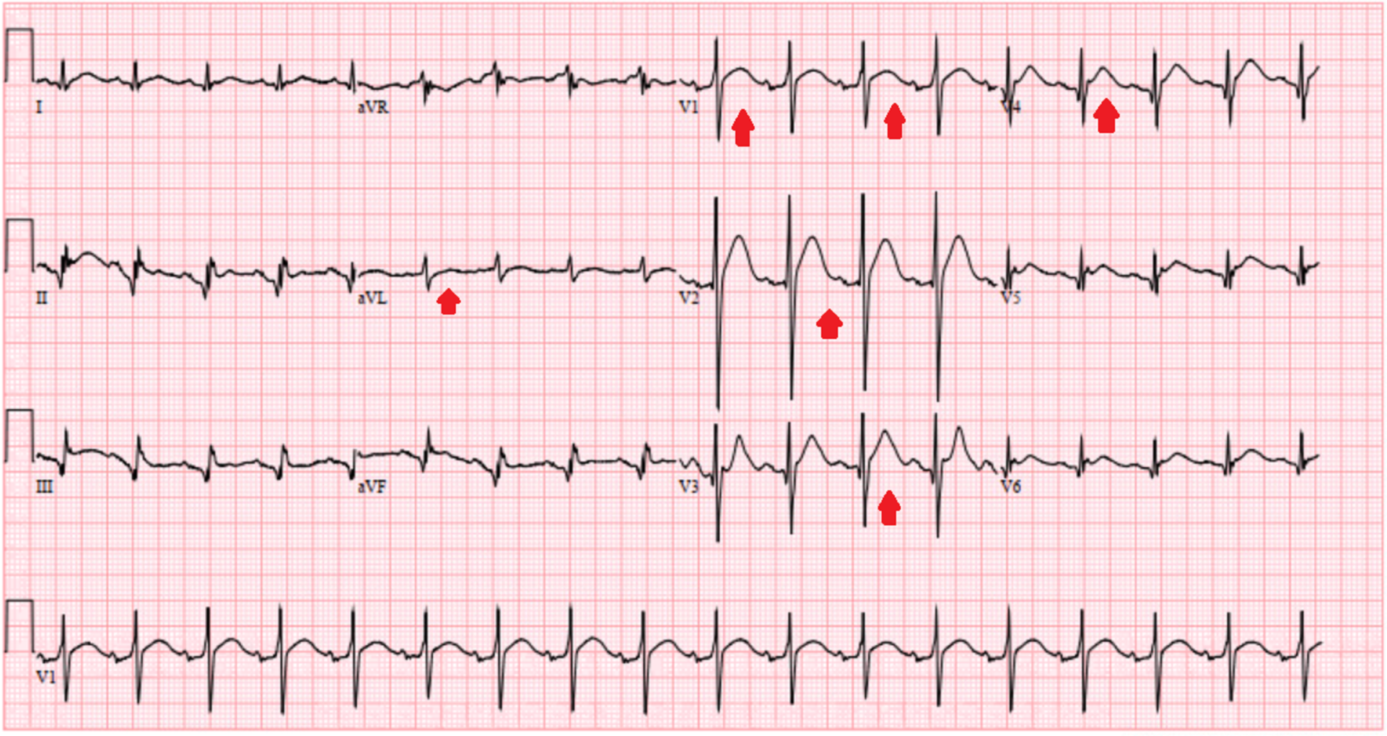 hypocalcemia-ekg