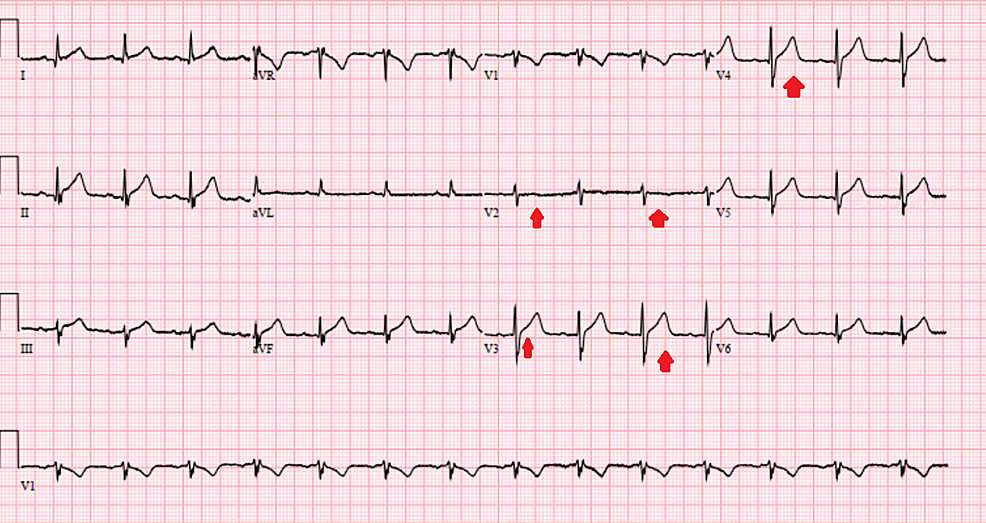 St elevation myocardial infarction