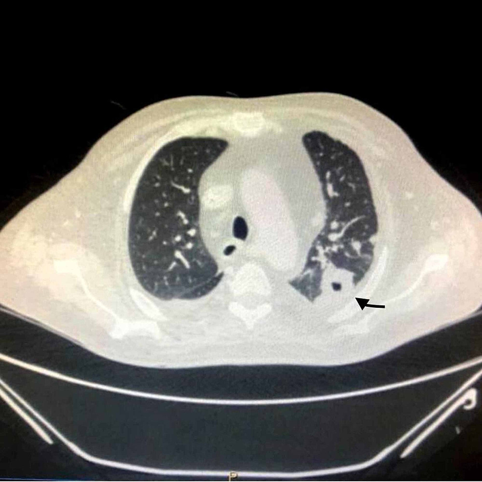 Cureus | Pulmonary Cryptococcosis in a Human Immunodeficiency Virus ...