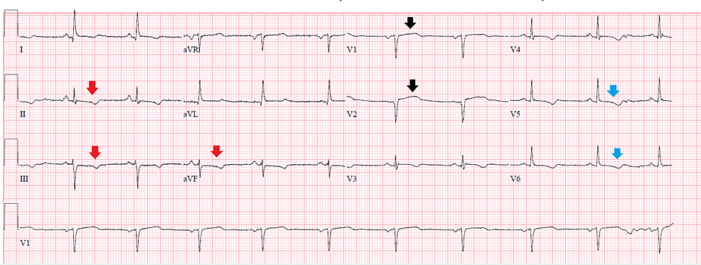 FULL TEXT - Mid-ventricular takotsubo: A case report - International  Journal of Case Reports and Images (IJCRI)