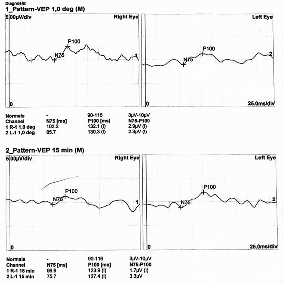 l carnitine benefits in lhon The Role of L-Carnitine Kidney Disease and Related Metabolic Dysfunctions L-Carnitine
