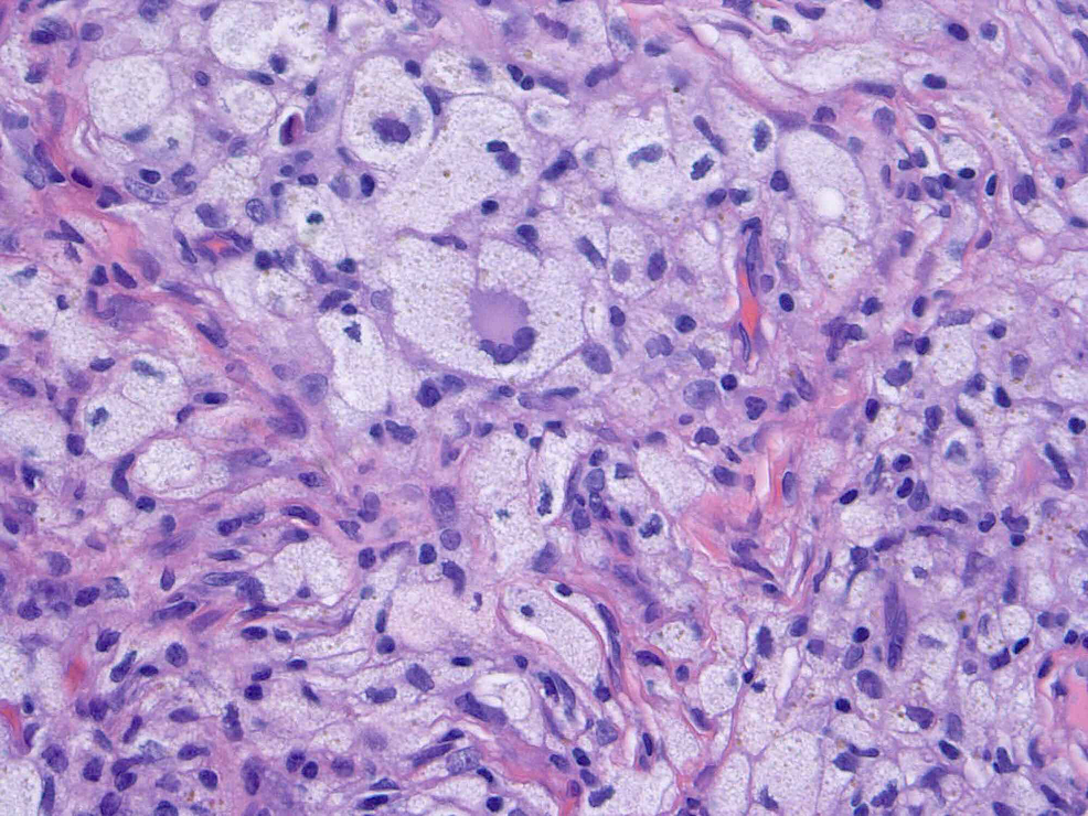 Cureus | Multiple Xanthogranulomas in a Teenager