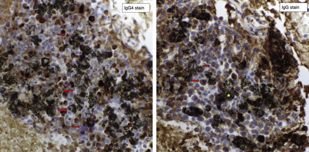 Zespół nadmiernej lepkości w chorobach związanych z immunoglobuliną G4 (IgG4) i zastosowanie terapeutycznej wymiany osocza: opis przypadku.