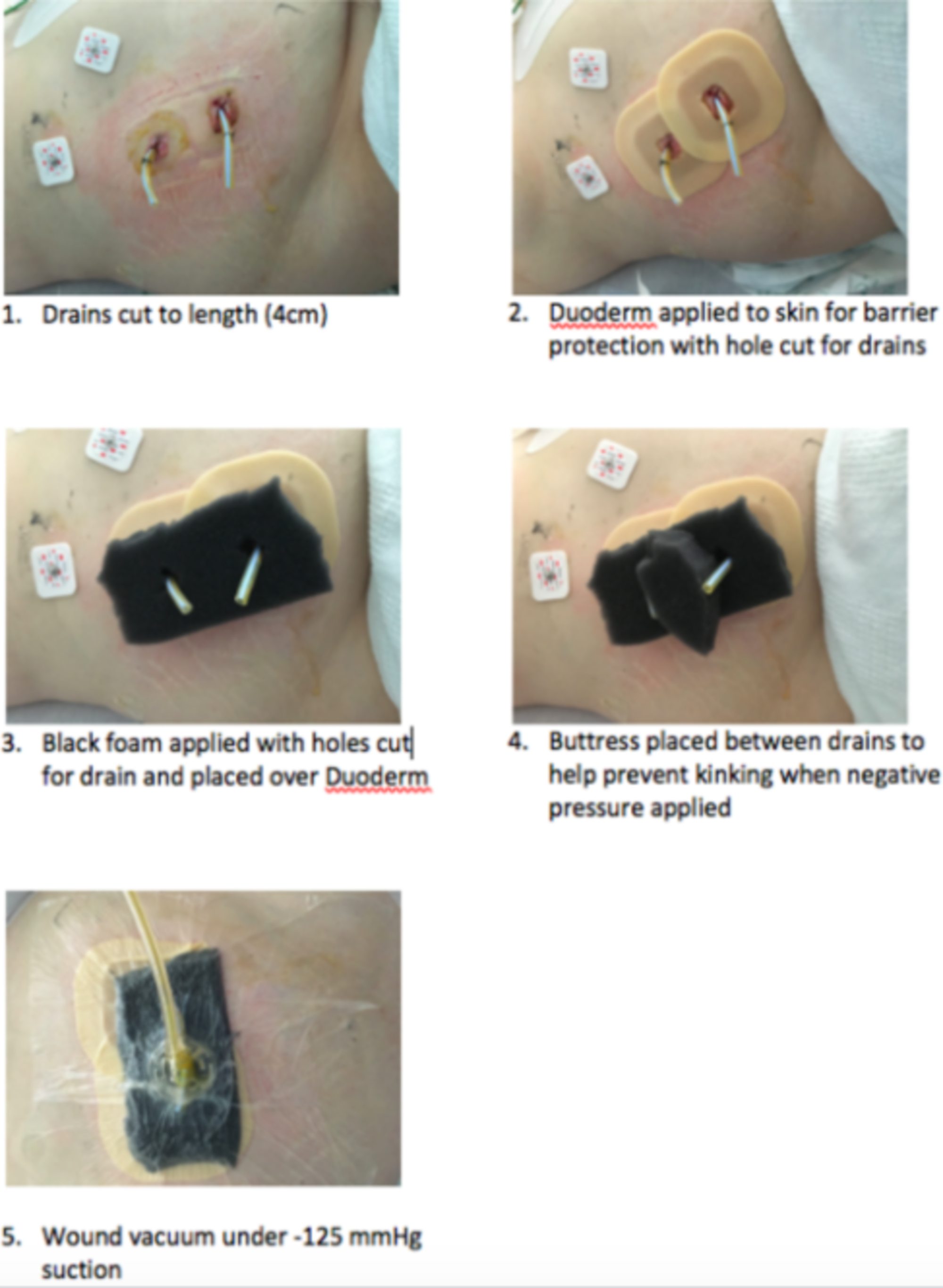 negative pressure wound therapy vac