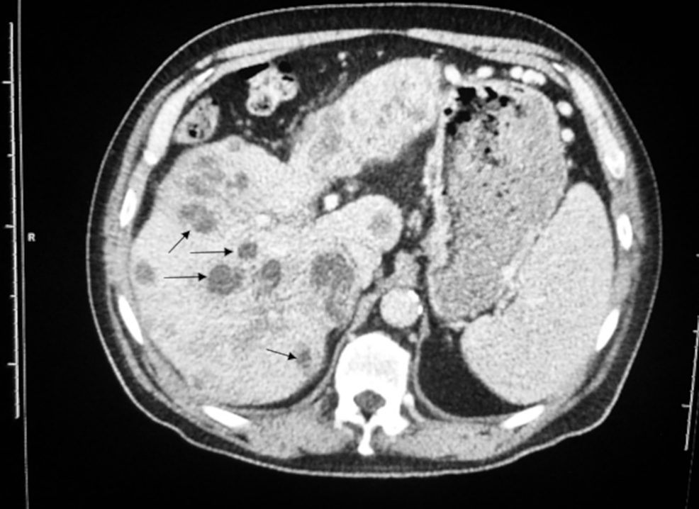 Streptococcus mitis Abscesses Mimicking Liver Metastases Cureus