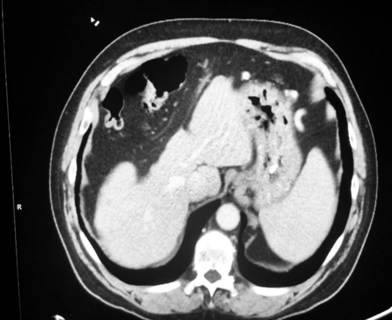 Cureus Streptococcus mitis Abscesses Mimicking Liver Metastases