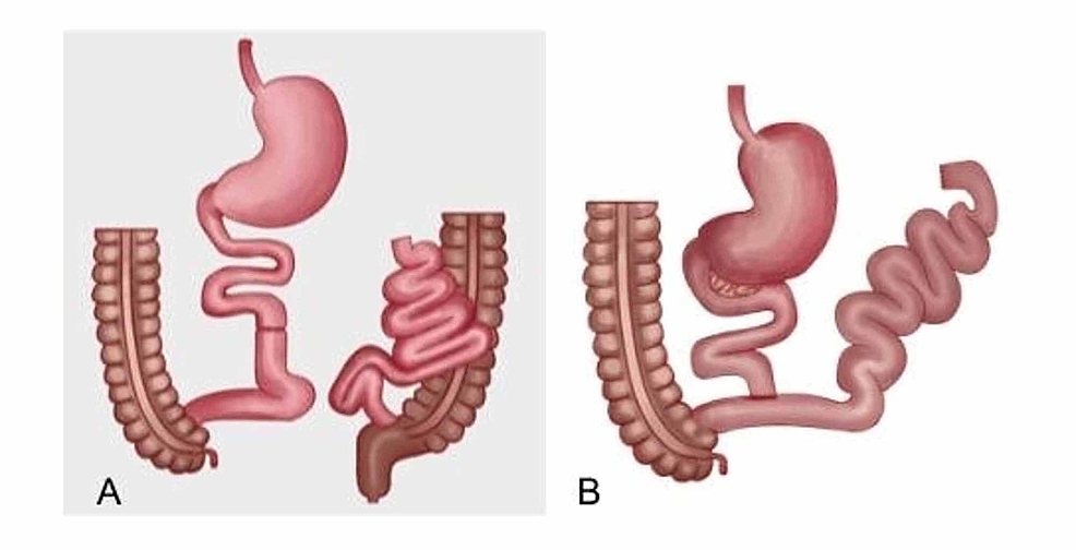 Cureus | Jejunal-Ileal Bypass And Its Complications: Case Report And ...