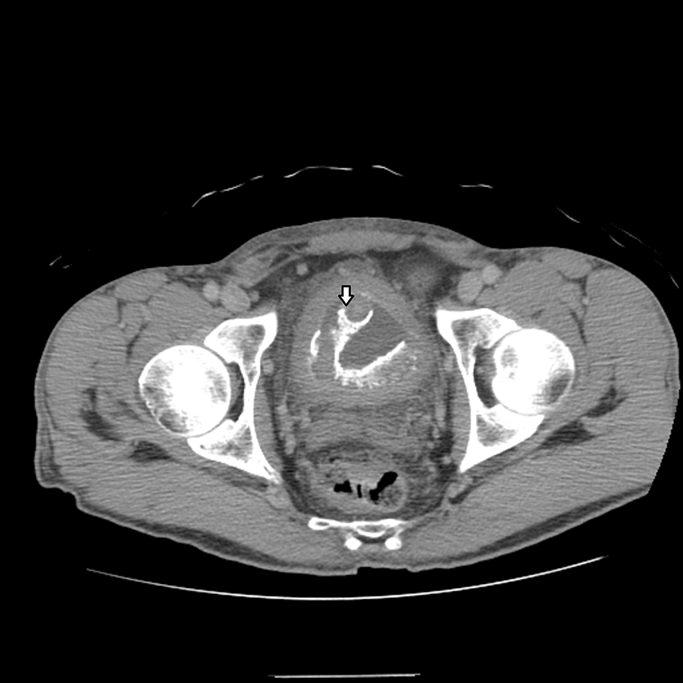 CT-urogram-demonstrating-coiled-tube-like-structure-in-the-urinary-bladder.-