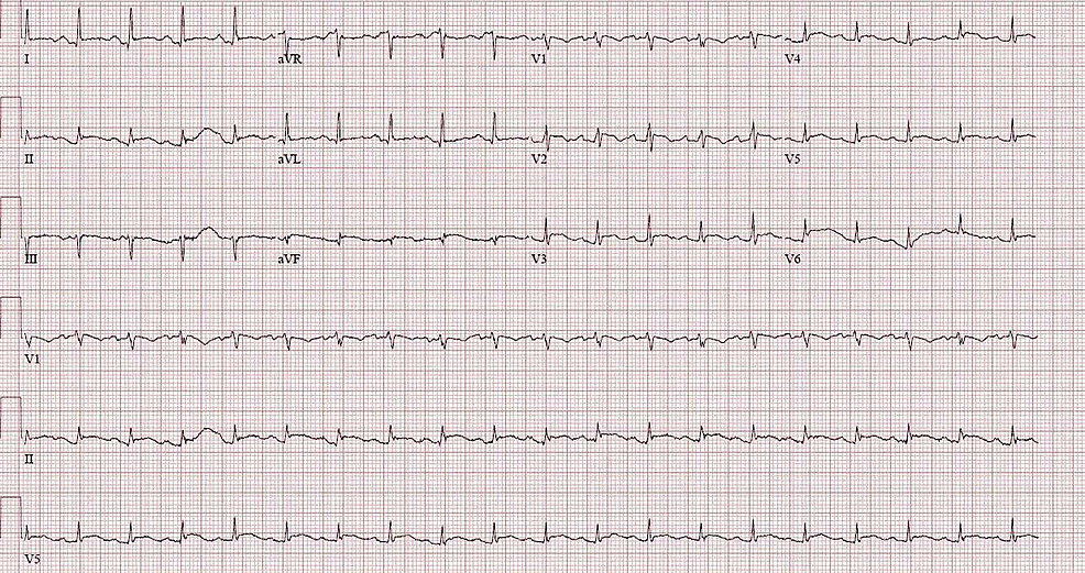 Electrocardiogram-(EKG)