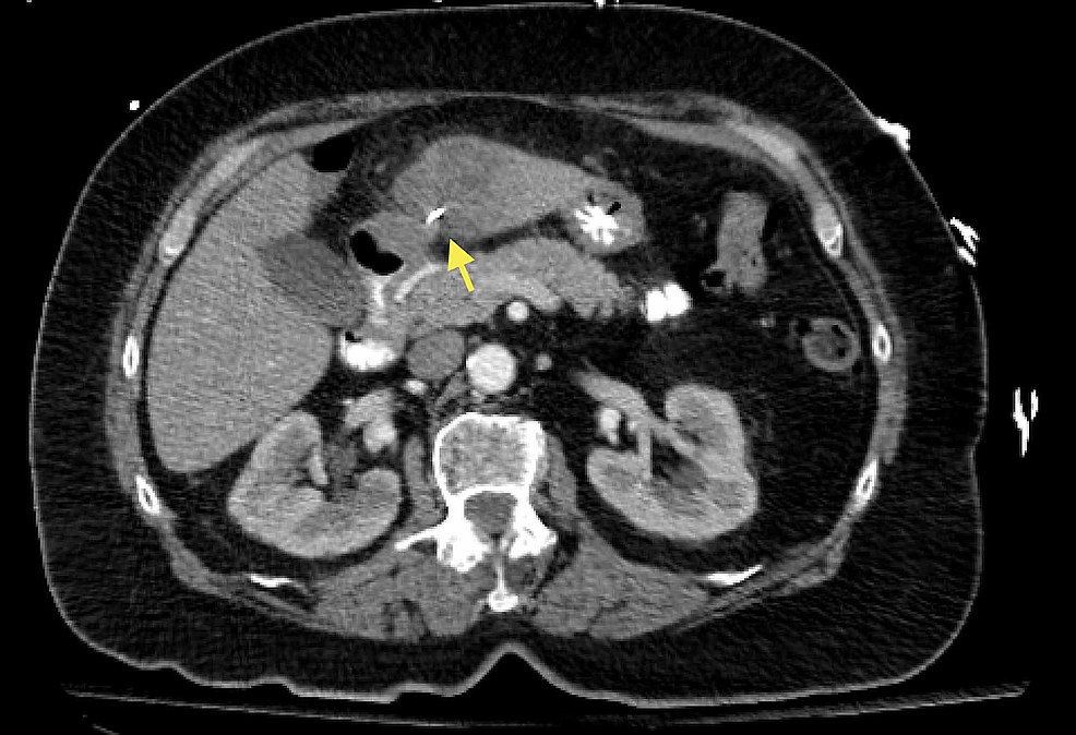 Cureus | Liver Abscess Caused by Ingestion of a Sewing Needle