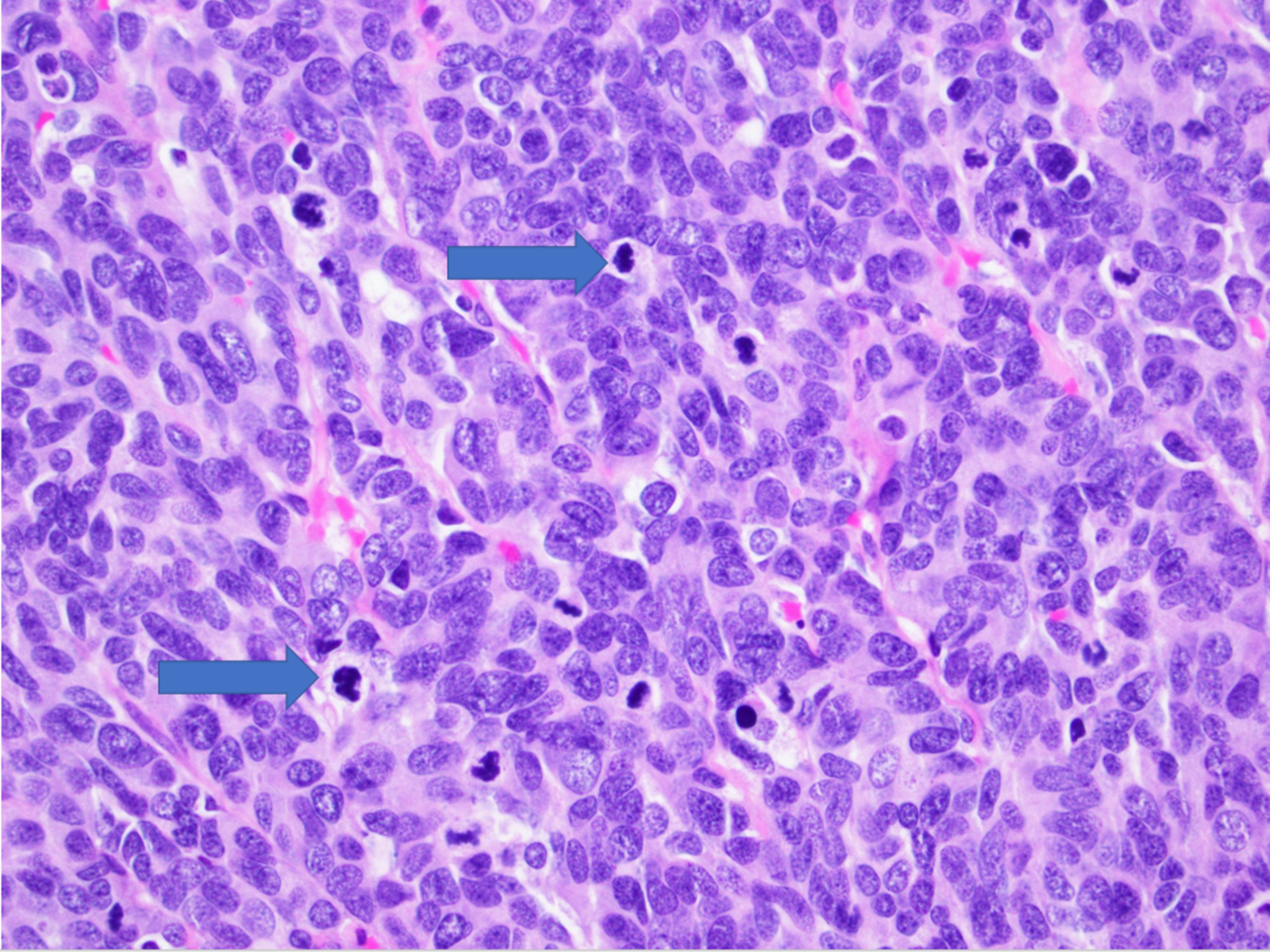 Cureus | Sixty-One-Year-Old Female With Metastatic Poorly ...