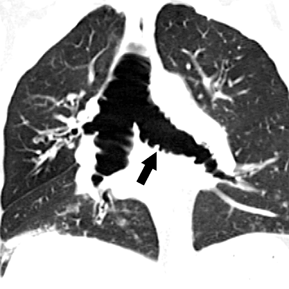 Congenital Tracheobronchomegaly (MounierKuhn Syndrome) in a Woman with