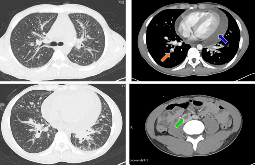 YoungOnset, ROS1Rearranged Adenocarcinoma of the Lung With Cardiac Tamponade A Case Report