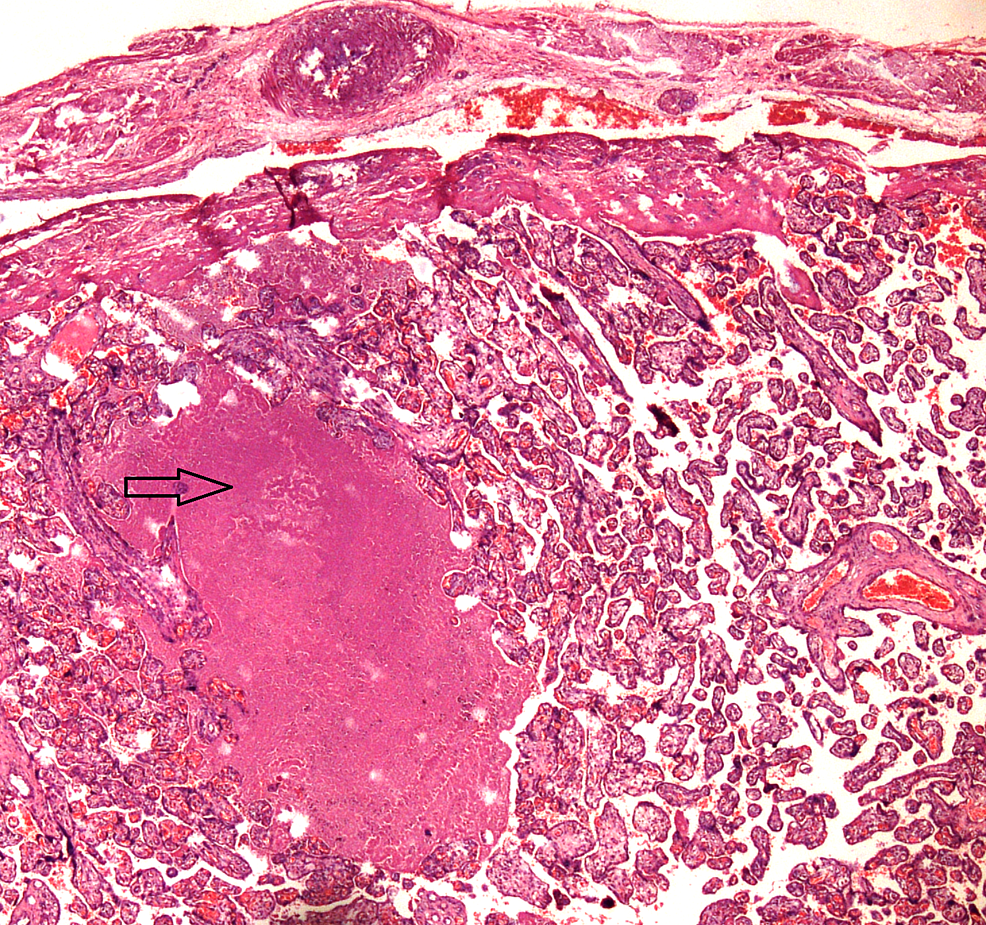 Cureus  Posttraumatic Corpus Luteal Cyst Rupture: A Diagnostic