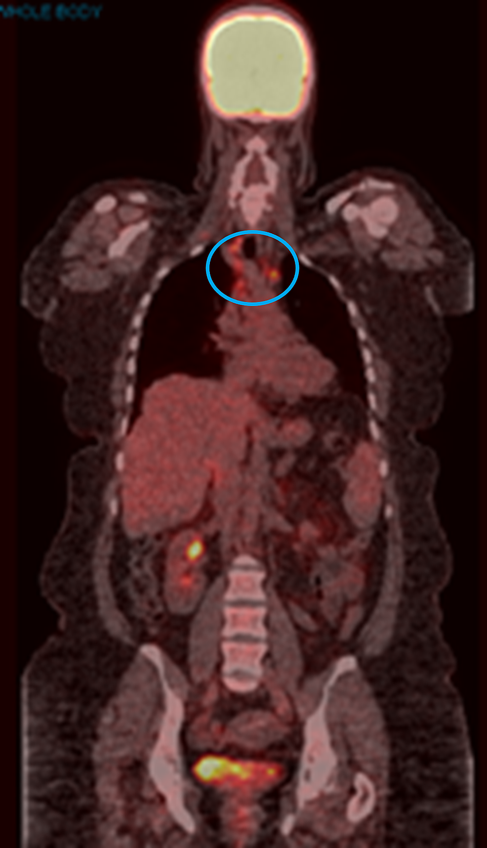 Cureus | Pembrolizumab-Induced Sarcoid-Like Reaction: FDG-PET Scan