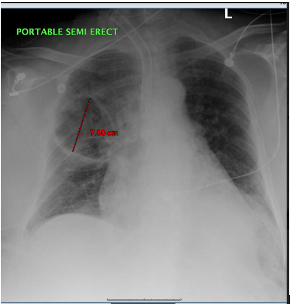 Rare but Fatal Case of Cavitary Pneumonia Caused by Alcaligenes ...