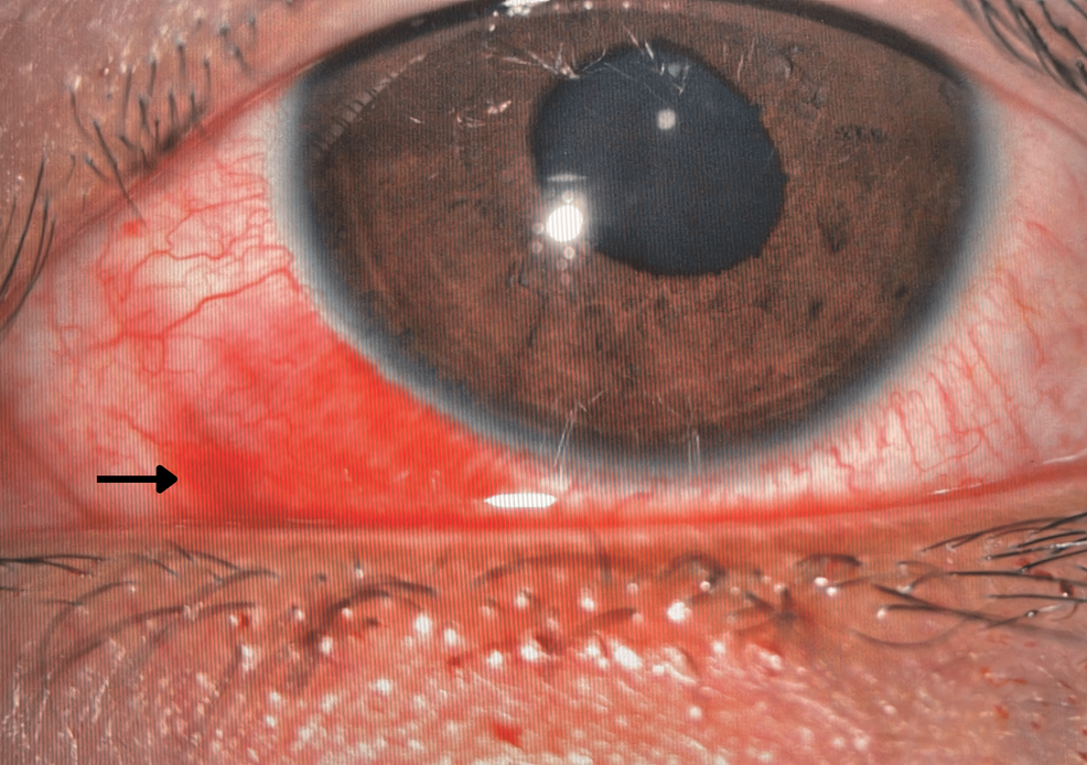 Peripheral Retinal Tear Following Football Ocular Trauma