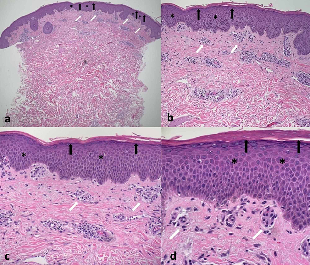 Cureus | Tinea Corporis Masquerading as a Diffuse Gyrate Erythema: Case ...