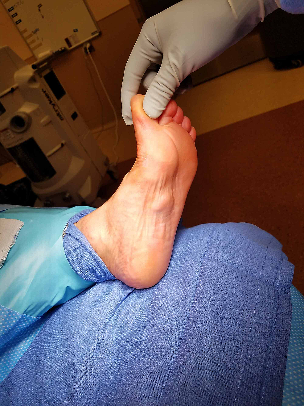 Closed-Incision Negative Pressure Therapy in Place of Surgical Drain Placement in Plantar Fibroma Excision Surgery: A Case Series