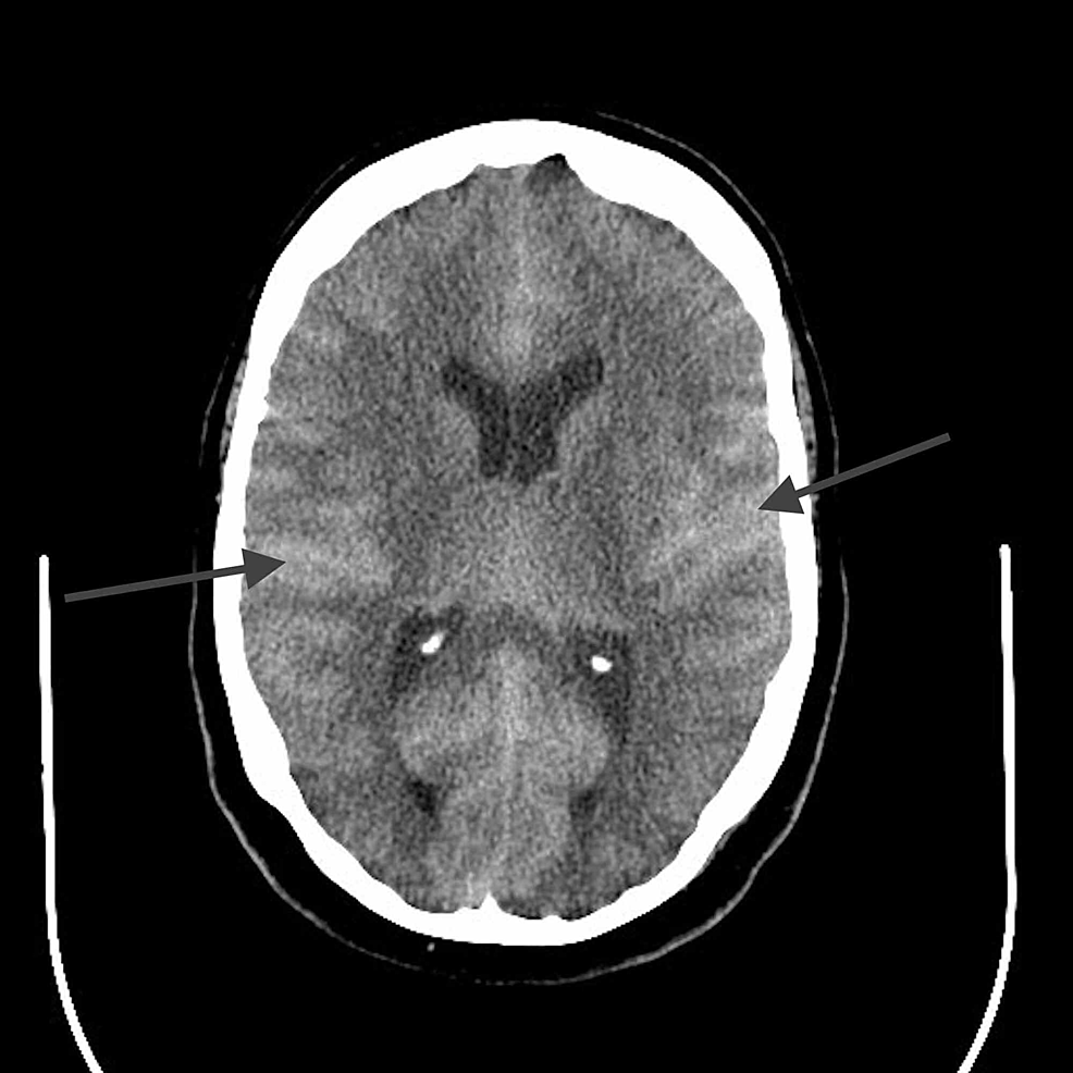 Cureus | Long-Term Sequela of Intrathecal Gadolinium Extravasation ...