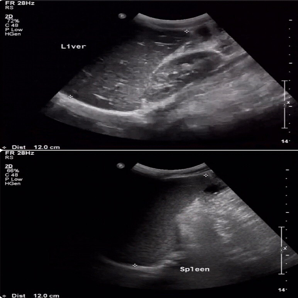 Abdominal-ultrasound-showing-hepatosplenomegaly