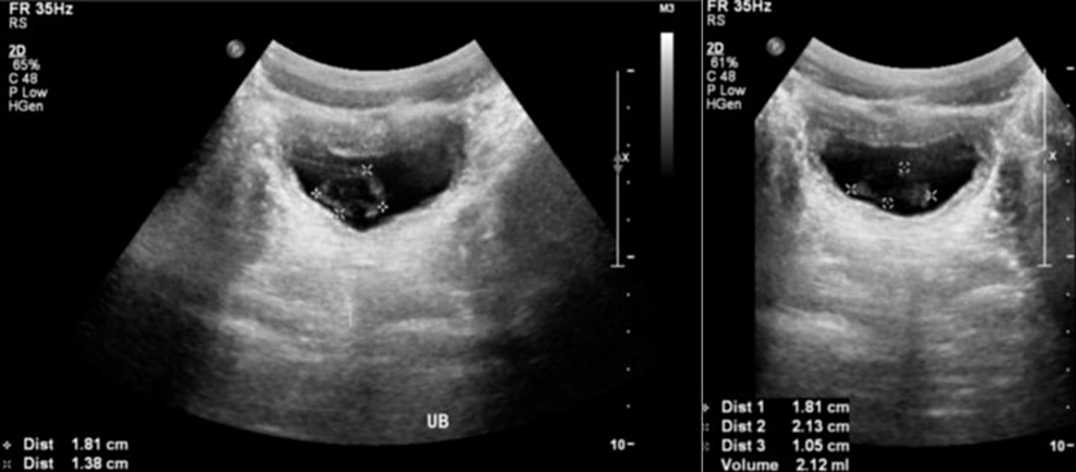 Renal-ultrasound-showing-thickened-urinary-bladder-wall