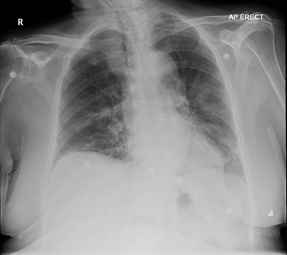 A Case of Combined Diabetic Ketoacidosis and Hyperosmolar Hyperglycemic ...