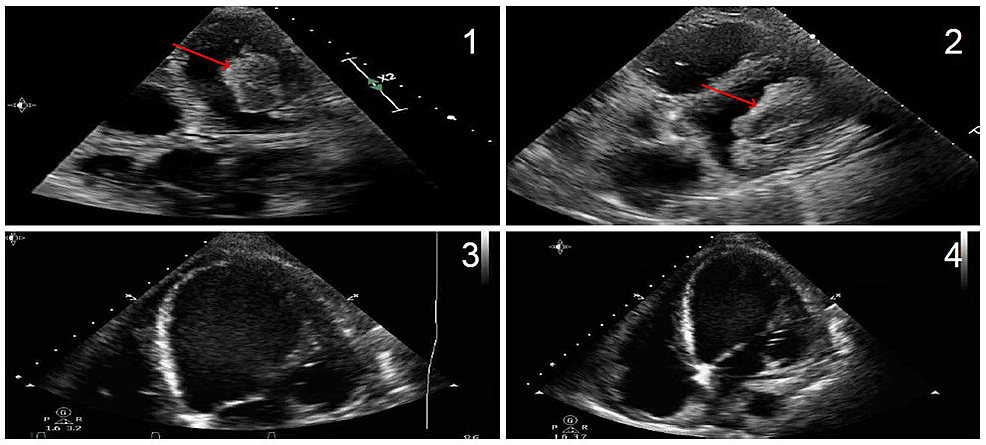 Cureus | Giant Left Ventricular Thrombus Formation in the Setting of Severe Aortic Stenosis and ...