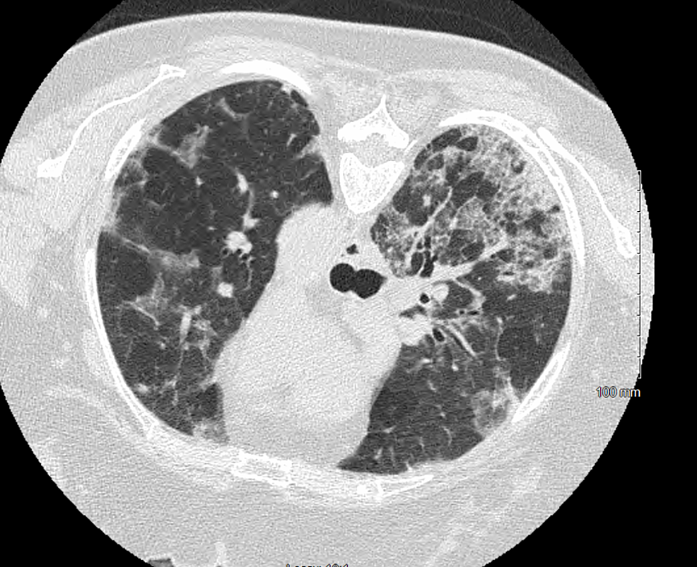 Cureus DaptomycinInduced Eosinophilic Pneumonia Mimicking Multifocal