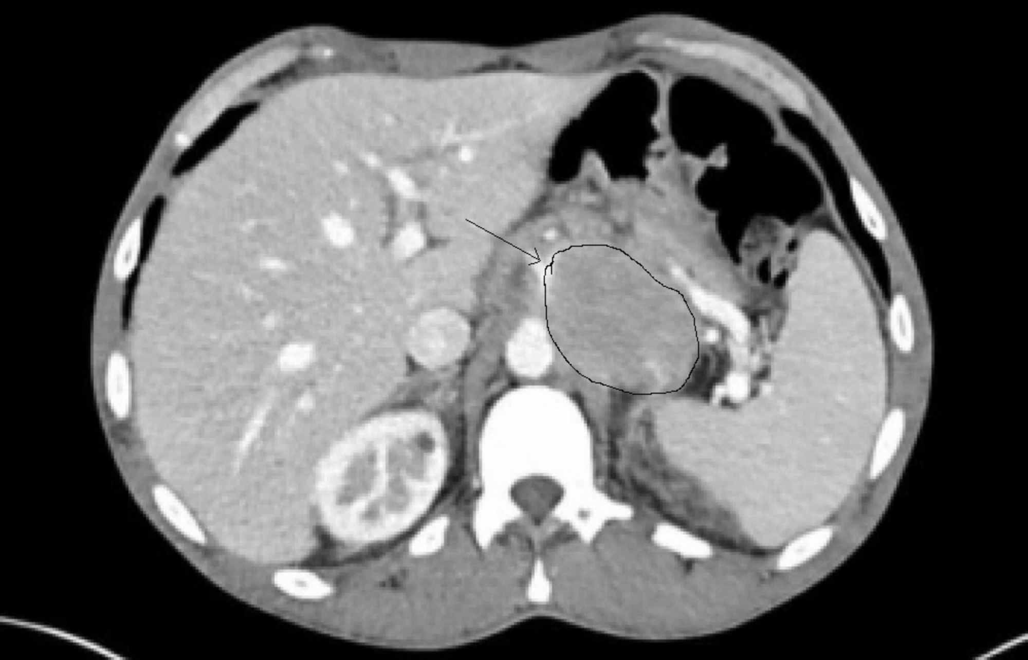 ic10 code soft tissue mass