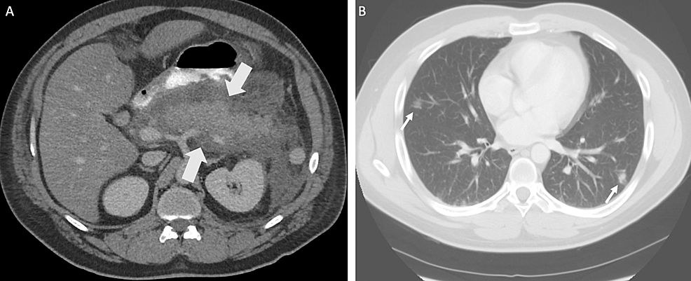 CT-showing-acute-pancreatitis