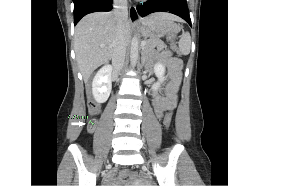 Appendicitis On Ct Scan