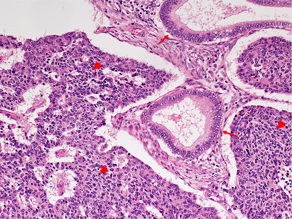 Cureus Neuroendocrine Carcinoma of Uterine Cervix Stereotactic