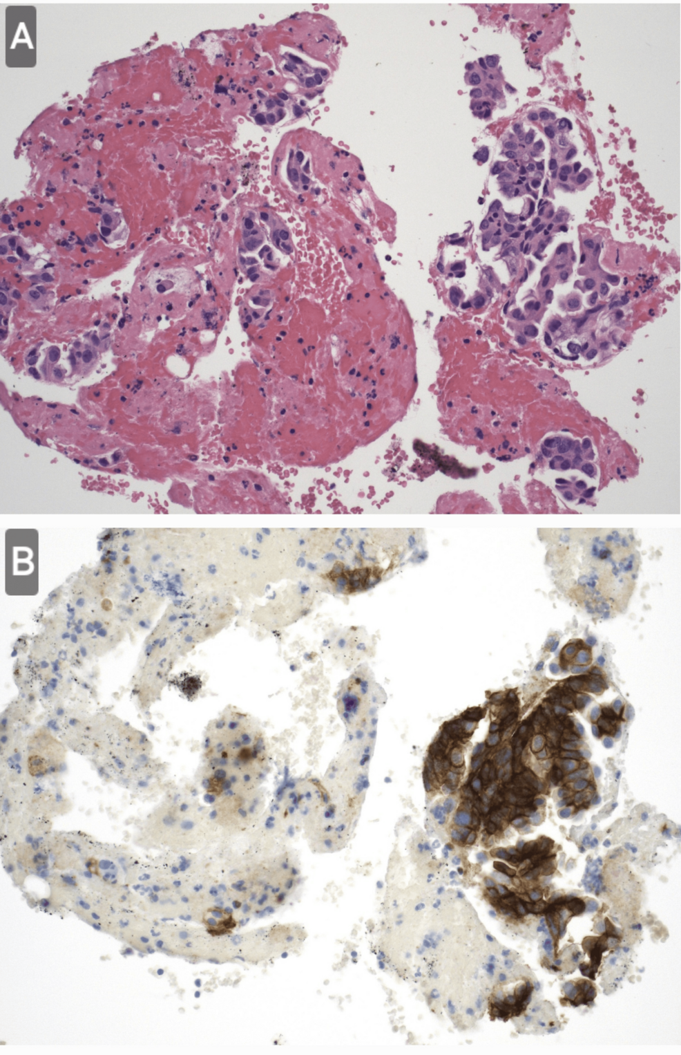 Radiotherapy for Lung Cancer: An Unrecognized Cause of Lung Torsion