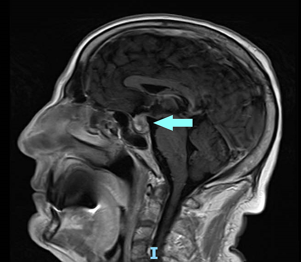 Cureus | Atypical Presentation of Panhypopituitarism