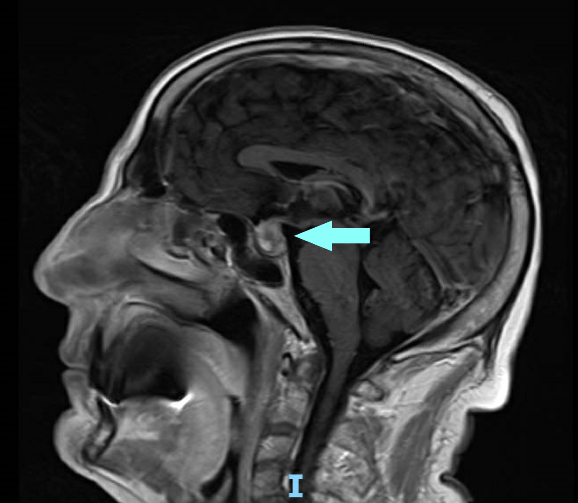 Pituitary Adenoma On Mri | My XXX Hot Girl