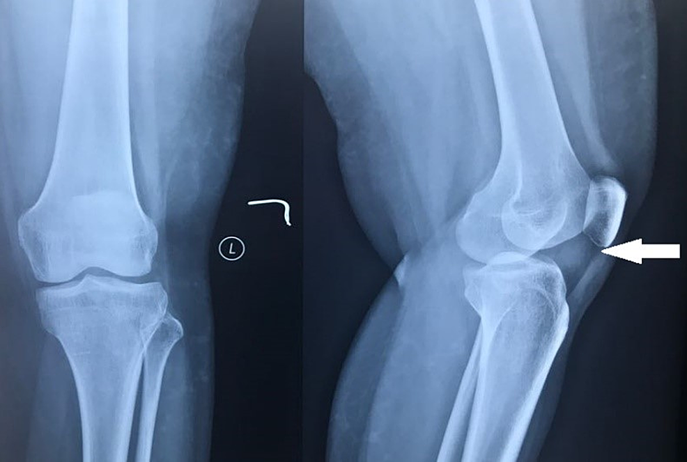 Cureus Unusual Occurrence of Tenosynovial Giant Cell Tumor in Hoffa's