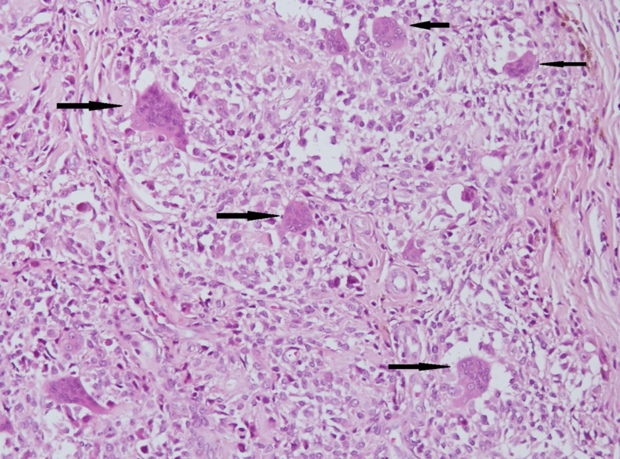 Cureus Unusual Occurrence Of Tenosynovial Giant Cell Tumor In Hoffas