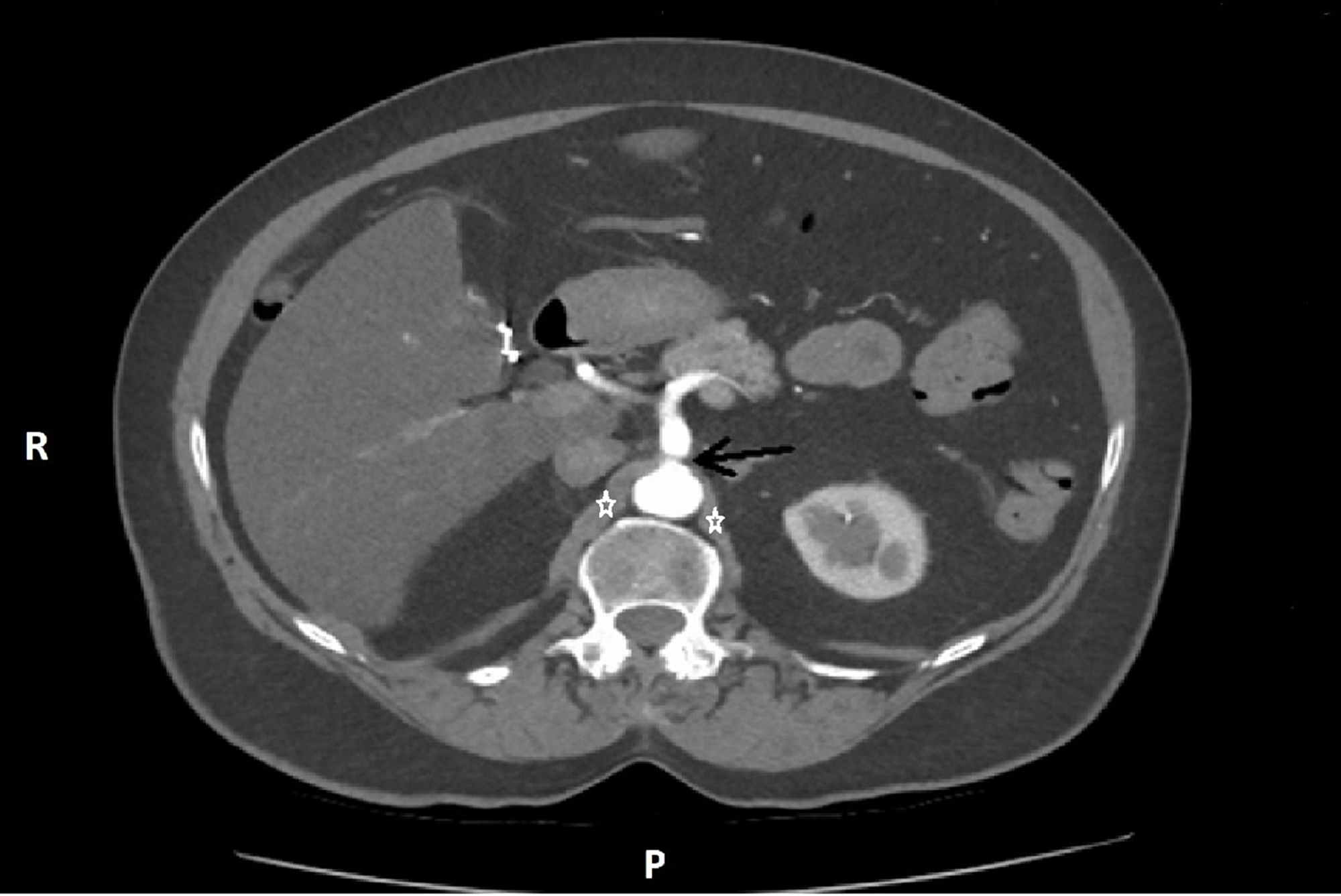 celiac artery cat