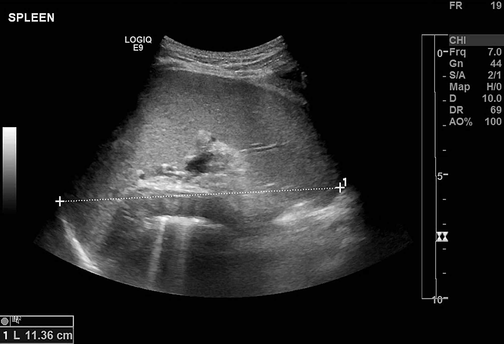 cureus-parvovirus-b19-infection-mimicking-juvenile-myelomonocytic