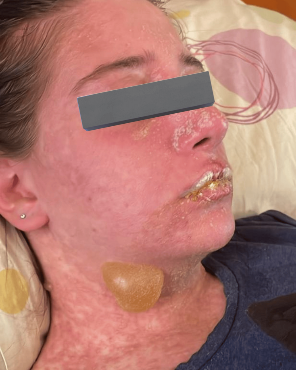 glutathione lupus reddit Amazon.com: Now Glutatión 500 mg, 100 cápsulas veganas (paquete de 2) –  Suplemento GSH de forma reducida – Mejorado con extracto de cardo mariano y  ácido alfa lipoico : Salud y Hogar main image 0